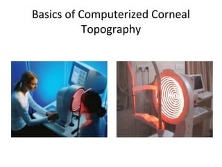 Basics of Computerized Corneal
Topography
 