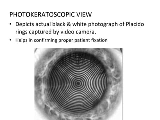 PHOTOKERATOSCOPIC VIEW
• Depicts actual black & white photograph of Placido
rings captured by video camera.
• Helps in confirming proper patient fixation
 