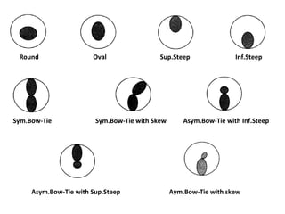 Aym.Bow-Tie with skew
Round Oval Sup.Steep Inf.Steep
Sym.Bow-Tie Sym.Bow-Tie with Skew Asym.Bow-Tie with Inf.Steep
Asym.Bow-Tie with Sup.Steep
 