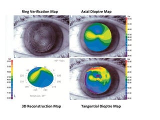Ring Verification Map Axial Dioptre Map
3D Reconstruction Map Tangential Dioptre Map
 