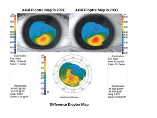 Axial Dioptre Map in 2002 Axial Dioptre Map in 2003
Difference Dioptre Map
 