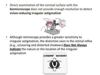 • Direct examination of the corneal surface with the
biomicroscope does not provide enough resolution to detect
vision-reducing irregular astigmatism
• Although retinoscopy provides a greater sensitivity to
irregular astigmatism, the distortion seen in the retinal reflex
(e.g., scissoring and distorted shadows) Does Not Always
Indicate the nature or the location of the irregular
astigmatism
 