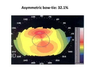 Asymmetric bow-tie: 32.1%
 