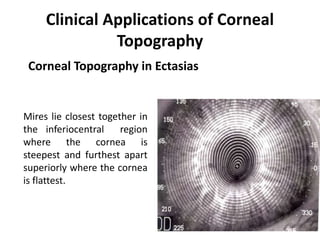 Clinical Applications of Corneal
Topography
Corneal Topography in Ectasias
Mires lie closest together in
the inferiocentral region
where the cornea is
steepest and furthest apart
superiorly where the cornea
is flattest.
 