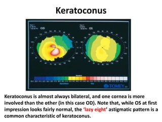 Keratoconus
Keratoconus is almost always bilateral, and one cornea is more
involved than the other (in this case OD). Note that, while OS at first
impression looks fairly normal, the ‘lazy eight’ astigmatic pattern is a
common characteristic of keratoconus.
 
