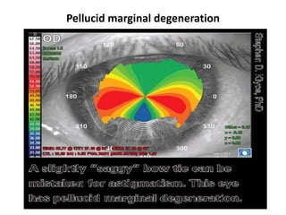Pellucid marginal degeneration
 