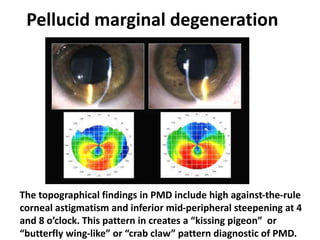 Pellucid marginal degeneration
The topographical findings in PMD include high against-the-rule
corneal astigmatism and inferior mid-peripheral steepening at 4
and 8 o’clock. This pattern in creates a “kissing pigeon” or
“butterfly wing-like” or “crab claw” pattern diagnostic of PMD.
 