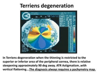 Terriens degeneration
In Terriens degeneration when the thinning is restricted to the
superior or inferior area of the peripheral cornea, there is relative
steepening approximately 90 deg away. ATR Astigmatism..with
vertical flattening….The diagnosis always requires a pachymetry map.
 