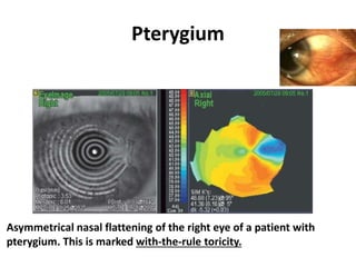 Pterygium
Asymmetrical nasal flattening of the right eye of a patient with
pterygium. This is marked with-the-rule toricity.
 