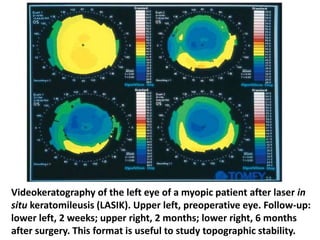 Videokeratography of the left eye of a myopic patient after laser in
situ keratomileusis (LASIK). Upper left, preoperative eye. Follow-up:
lower left, 2 weeks; upper right, 2 months; lower right, 6 months
after surgery. This format is useful to study topographic stability.
 