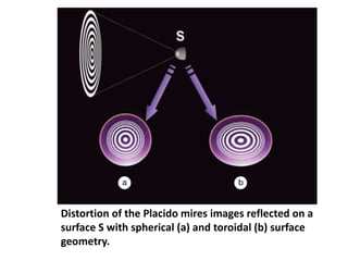 Distortion of the Placido mires images reflected on a
surface S with spherical (a) and toroidal (b) surface
geometry.
 