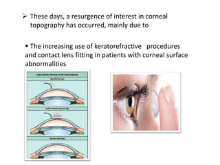  These days, a resurgence of interest in corneal
topography has occurred, mainly due to
 The increasing use of keratorefractive procedures
and contact lens fitting in patients with corneal surface
abnormalities
 