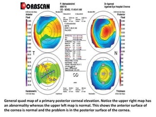 General quad map of a primary posterior corneal elevation. Notice the upper right map has
an abnormality whereas the upper left map is normal. This shows the anterior surface of
the cornea is normal and the problem is in the posterior surface of the cornea.
 