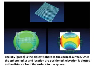 The BFS (green) is the closest sphere to the corneal surface. Once
the sphere radius and location are positioned, elevation is plotted
as the distance from the surface to the sphere.
 