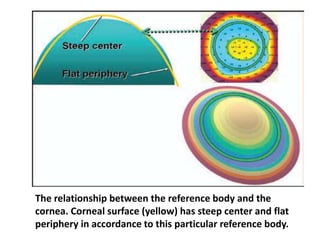 The relationship between the reference body and the
cornea. Corneal surface (yellow) has steep center and flat
periphery in accordance to this particular reference body.
 