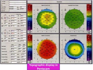 Topographic display in
Pentacam
 