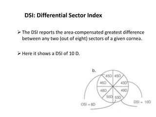DSI: Differential Sector Index
The DSI reports the area-compensated greatest difference
between any two (out of eight) sectors of a given cornea.
Here it shows a DSI of 10 D.
 