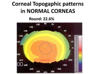 Corneal Topogaphic patterns
in NORMAL CORNEAS
Round: 22.6%
 