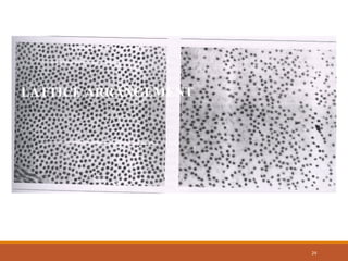 24
LATTICE ARRANGEMENT
SWOLLEN CORNEA
 