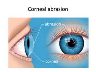 Corneal abrasion
 