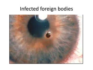 Infected foreign bodies
 