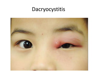 Dacryocystitis
 