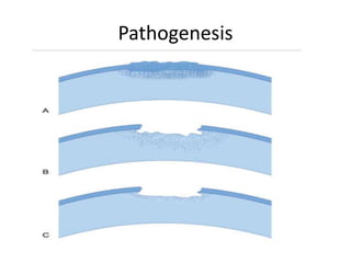 Pathogenesis
 