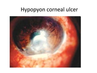 Hypopyon corneal ulcer
 