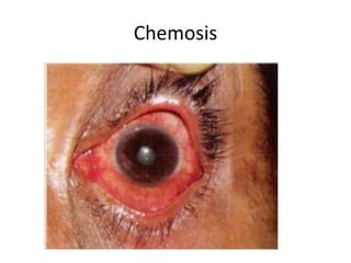 Chemosis
 