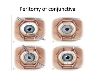 Peritomy of conjunctiva
 