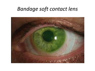 Bandage soft contact lens
 