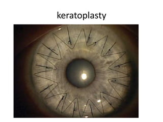 keratoplasty
 