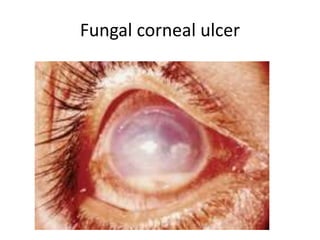 Fungal corneal ulcer
 