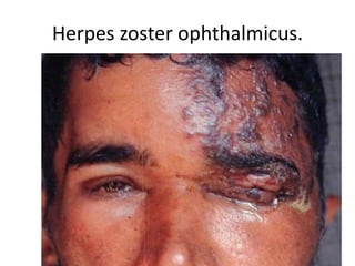 Herpes zoster ophthalmicus.
 