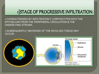 CHARACTERIZED BY INFILTRATION F LYMPHOCYTES INTO THE
EPITHELIUM FROM THE PERIPHERAL CIRCULATION & THE
UNDERLYING STROMA.
SUBSEQUENTLY, NECROSIS OF THE INVOLVED TISSUE MAY
OCCUR.
 