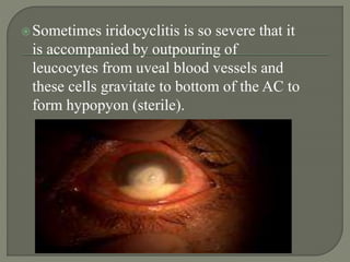 Sometimes iridocyclitis is so severe that it
is accompanied by outpouring of
leucocytes from uveal blood vessels and
these cells gravitate to bottom of the AC to
form hypopyon (sterile).
 