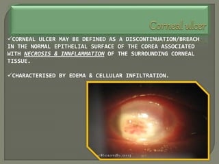 CORNEAL ULCER MAY BE DEFINED AS A DISCONTINUATION/BREACH
IN THE NORMAL EPITHELIAL SURFACE OF THE COREA ASSOCIATED
WITH NECROSIS & INNFLAMMATION OF THE SURROUNDING CORNEAL
TISSUE.
CHARACTERISED BY EDEMA & CELLULAR INFILTRATION.
 