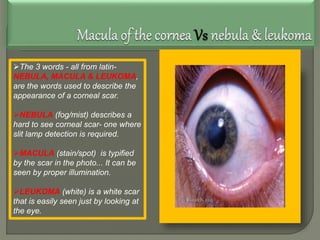 The 3 words - all from latin-
NEBULA, MACULA & LEUKOMA,
are the words used to describe the
appearance of a corneal scar.
NEBULA (fog/mist) describes a
hard to see corneal scar- one where
slit lamp detection is required.
MACULA (stain/spot) is typified
by the scar in the photo... It can be
seen by proper illumination.
LEUKOMA (white) is a white scar
that is easily seen just by looking at
the eye.
 