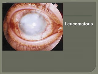 Leucomatous
 