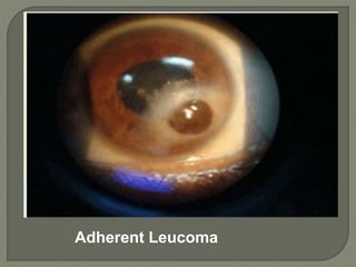 Adherent Leucoma
 
