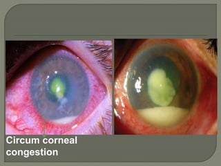 Circum corneal
congestion
 