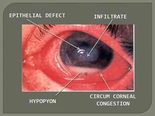 INFILTRATE
EPITHELIAL DEFECT
HYPOPYON
CIRCUM CORNEAL
CONGESTION
 