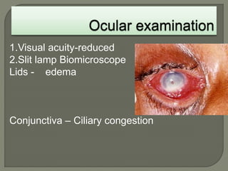 1.Visual acuity-reduced
2.Slit lamp Biomicroscope
Lids - edema
Conjunctiva – Ciliary congestion
 