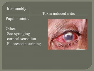 Iris- muddy
Toxin induced iritis
Pupil – miotic
Other:
-Sac syringing
-corneal sensation
-Fluorescein staining
 