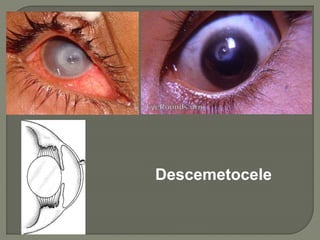 Descemetocele
 