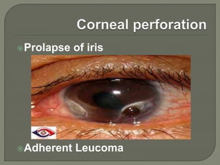 Prolapse of iris
Adherent Leucoma
 