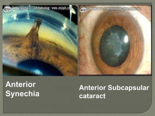 Anterior Subcapsular
cataract
Anterior
Synechia
 