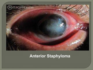 Anterior Staphyloma
 