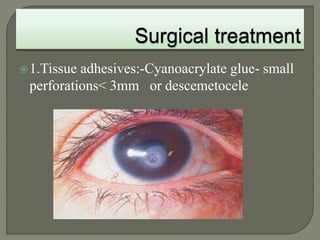 1.Tissue adhesives:-Cyanoacrylate glue- small
perforations< 3mm or descemetocele
 