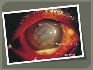 Wesseley ring
Hypopyon
 